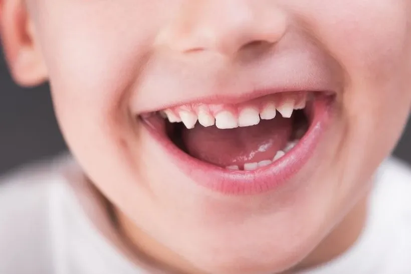 Dente de leite com cárie pode cair antes do tempo?