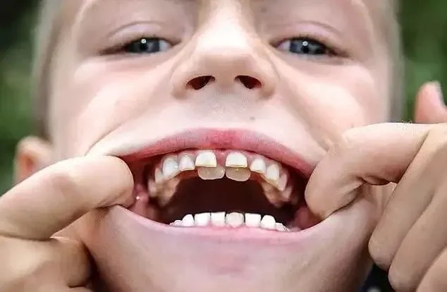 Quando um dente permanente nasce antes do dente de leite cair: o que fazer?